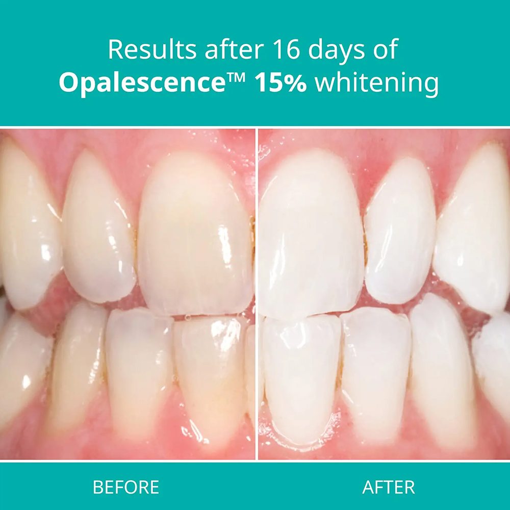 جل تبييض الأسنان طقم منزلي محا - مراجعة Teeth Whitening Gel Opalescence وسعره