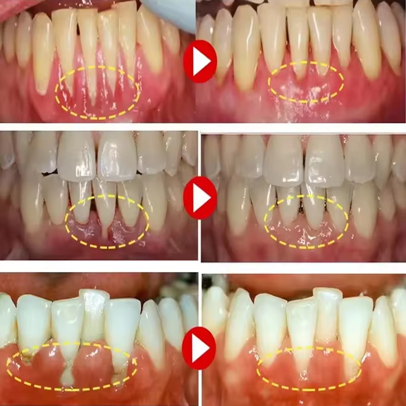 جل تبييض الأسنان للعناية باللث - مراجعة Teeth Whitening Gels وسعره