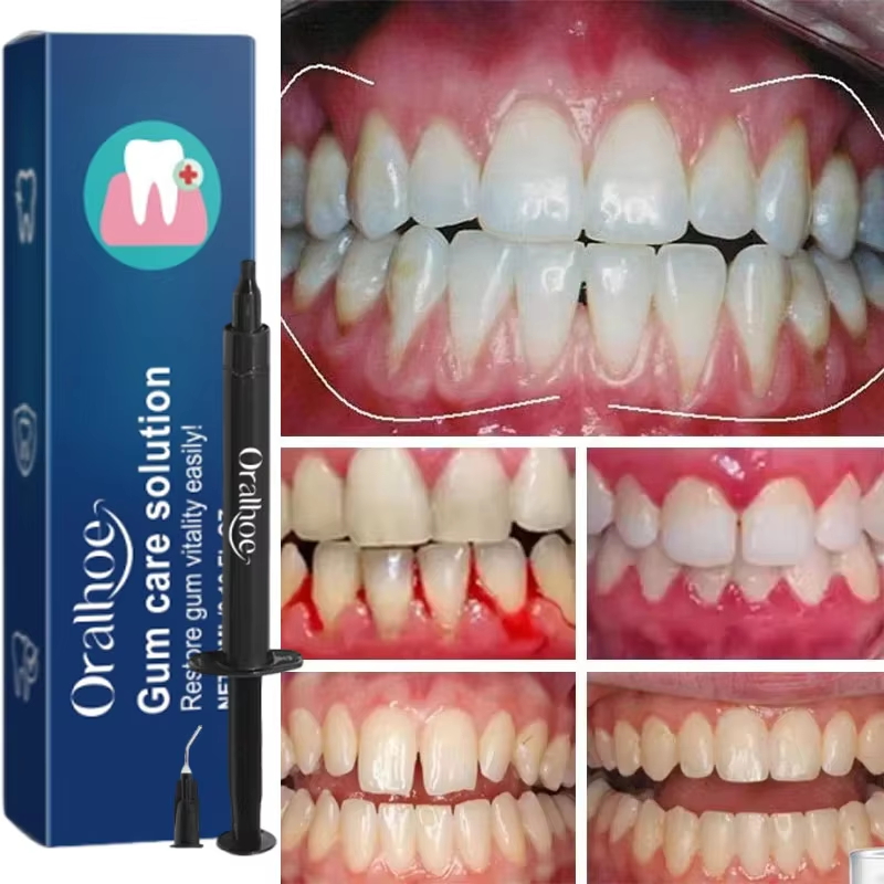 جل تبييض الأسنان للعناية باللث - مراجعة Teeth Whitening Gels وسعره