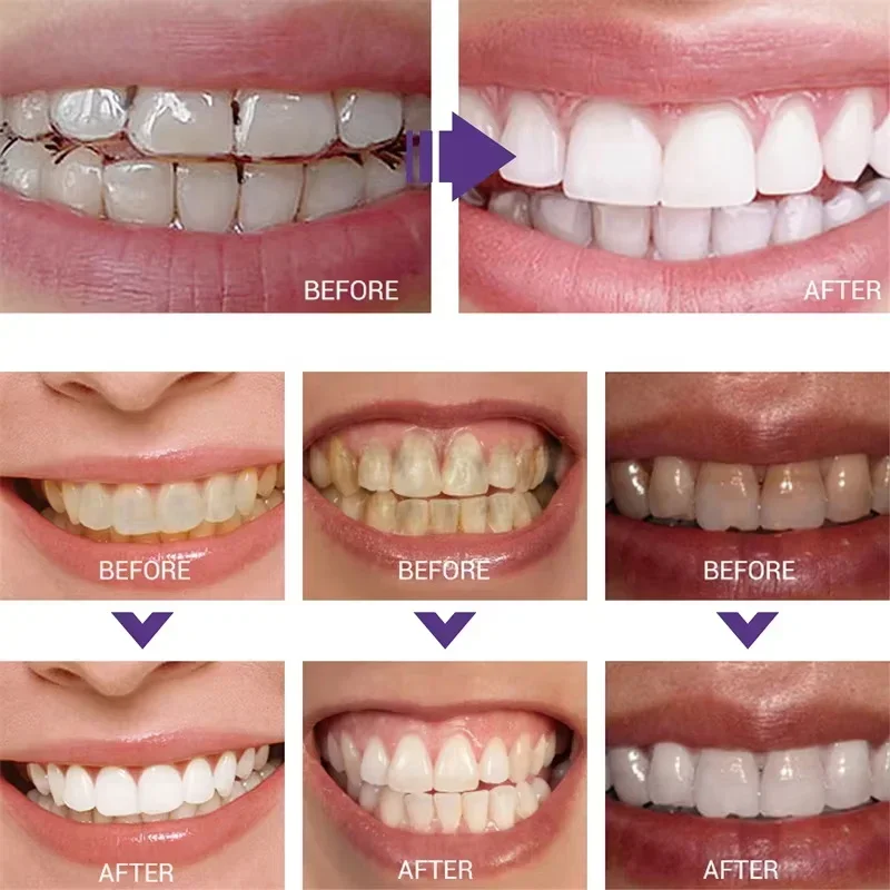 معجون أسنان مبيض لتنظيف الأسنا - مراجعة Teeth Whitening In Korea وسعره