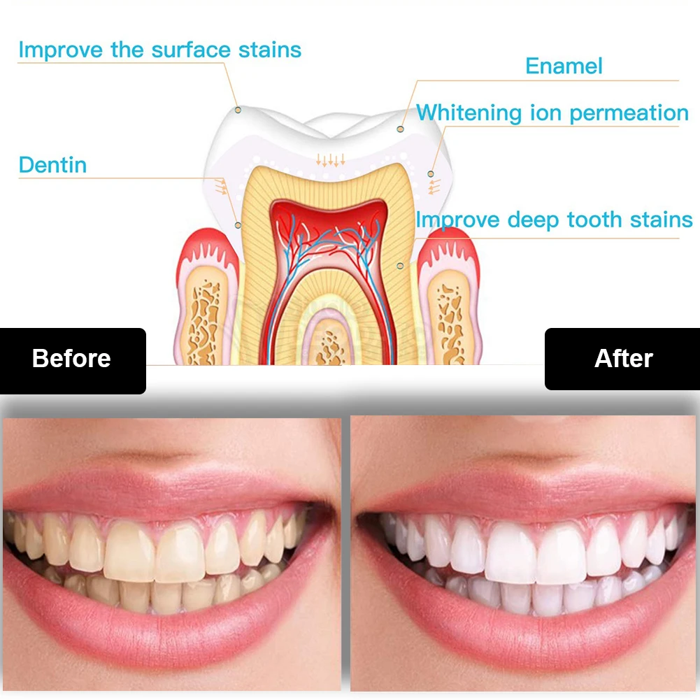 طقم تبييض الأسنان صغير 16 LED  - مراجعة Teeth Whitening Paste وسعره